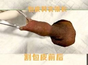 男人割了皮包后为什么要手举着？