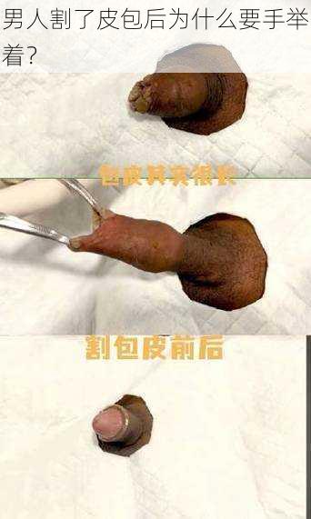 男人割了皮包后为什么要手举着？